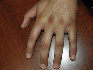 Placas de color marrón oscuro y aspecto aterciopelado sobre tercera, cuarta y quinta articulaciones metacarpofalángicas e interfalángicas de la mano derecha.