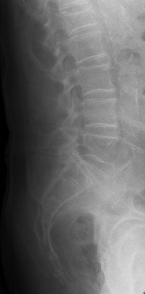 Radiografia convencional de columna lumbar. Perfil. Se aprecia una disminución de la altura del cuerpo vertebral L1, compatible con fractura por aplastamiento. Asimismo, calcificación de la pared arterial de la aorta abdominal.