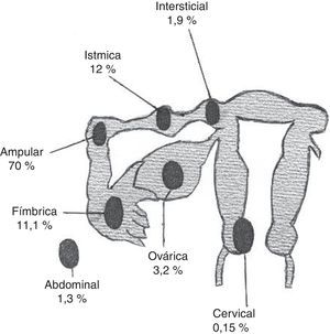 Localización anatómica y distribución porcentual del embarazo ectópico.