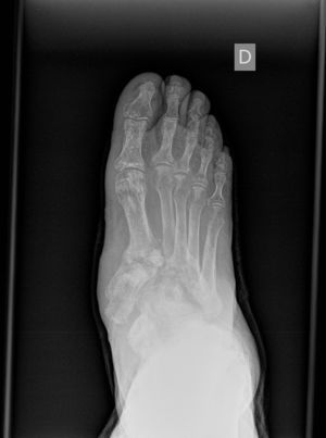 Radiografía anteroposterior de pie.