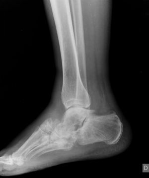 Radiografía lateral de pie.