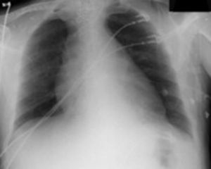 Radiografía de tórax con ensanchamiento mediastínico, signo radiológico clásico de la disección aórtica.