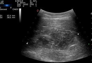 Ecografía de partes blandas que muestra hematoma intramuscular de 35×52×97mm.