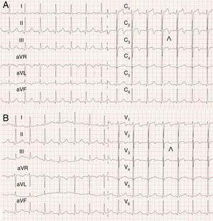 Electrocardiograma de 12derivaciones en el momento del ingreso (A) que sugieren isquemia coronaria (supradesnivel del ST con T isodifásicas en la cara anterior) y a las 4h (B) con alteraciones inespecíficas de la ondaT en precordiales (la punta de flecha señala los cambios evolutivos en la onda T de la derivación V2).