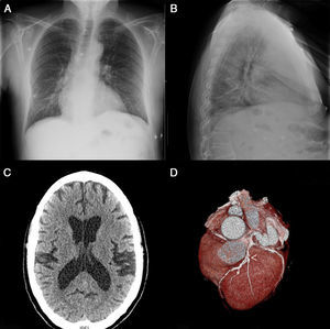 La radiografía de tórax en posteroanterior (A) y lateral (B) evidencia infiltrado a nivel basal del pulmón derecho. La tomografía computarizada (TC) cerebral (C) muestra prominencia de los surcos y cisuras cerebrales con dilatación del sistema ventricular. La angio-TC de arterias coronarias (D) muestra enfermedad significativa a nivel de la descendente anterior (punta de flecha) y de la circunfleja.