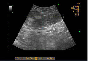 Ecografía abdominal, en la que se observa un engrosamiento del músculo recto anterior del abdomen con un área irregular de ecogenicidad heterogénea de unos 10cm de eje craneocaudal y 4cm de eje anteroposterior.