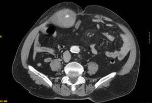 Tomografía axial computarizada abdominal. Se observa un voluminoso hematoma localizado a nivel del músculo recto anterior del abdomen derecho, que tenía una longitud máxima de 24cm y que presentaba sangrado activo.