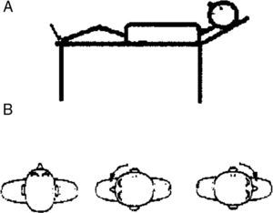 Maniobra de Pagnini-McClure o Roll Test. Paciente en posición supina con la cabeza inclinada 30° hacia arriba. Se gira la cabeza hacia el lado izquierdo para explorar el canal semicircular horizontal izquierdo, y luego a la derecha para explorar el canal semicircular horizontal derecho.