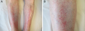 Imagen clínica. A. Lesiones purpúricas en ambas piernas. B. En mayor detalle, púrpura perifolicular.