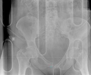 Radiografía de pelvis: fractura de rama isquiopúbica izquierda con luxación de sínfisis púbica.