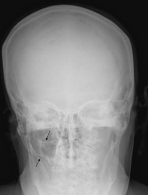 Radiografía simple que muestra el trayecto normal del arco cigomático derecho (flechas) y ausencia del mismo en el lado izquierdo.