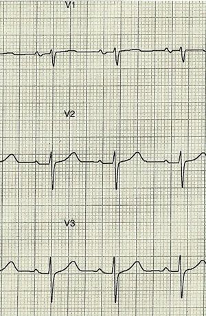 Electrocardiograma basal de la paciente previo a la toma de flecainida donde no se aprecia el patrón ECG de Brugada.