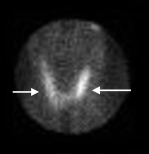 Gammagrafía tiroidea con radioyodo, que muestra ausencia de captación, lo que nos indica que no hay síntesis de hormona tiroidea y, por tanto, el hipertiroidismo es consecuencia de la liberación de hormona ya sintetizada debido a la destrucción glandular.