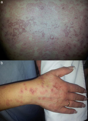 Detalle de las lesiones de tronco y mano. Lesiones confluentes con vasculitis cutánea (a), incluso con zona central necrótica en algunas de ellas (b).