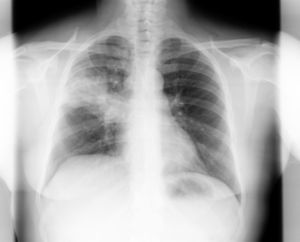 Rx de tórax a los 5 días del inicio del cuadro. Infiltrado en lóbulo superior del pulmón derecho.