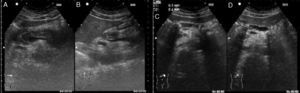 A y B. Pancreatitis aguda: corte transversal (A) y corte longitudinal a nivel de epigastrio, detectándose un páncreas hipoecogénico, aumentado de tamaño (B). C y D. Pancreatitis crónica: corte transversal (C) y corte longitudinal a nivel de epigastrio, donde se detecta un páncreas de ecogenicidad heterogénea, bordes mal definidos e irregulares, y múltiples calcificaciones intraductales en un conducto de Wirsung dilatado (D).
