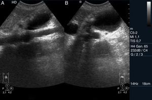 Seudoquiste pancreático. A. Corte longitudinal. B. Corte transversal a nivel de epigastrio, donde se detecta una lesión quística de paredes algo engrosadas e irregulares, localizada a nivel del cuerpo pancreático en un paciente con antecedentes de pancreatitis aguda.