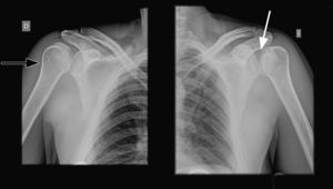 Radiografía anteroposterior de hombro bilateral. Se visualizan cambios sugestivos de luxación glenohumeral posterior. Signo de la glena vacía (flecha blanca). Signo del humero en bombilla (flecha negra).