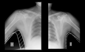 Radiografía anteroposterior de hombro posreducción.