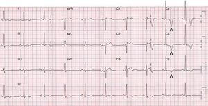 Electrocardiograma basal de 12 derivaciones donde se evidencia ritmo sinusal a 60lpm, bloqueo incompleto de rama derecha, ondas T negativas en cara inferior, V4-V6 (puntas de flecha) e isodifásicas en V3, con índice de Sokolow-Lyon de 40mm. Según este índice, que se calcula sumando S en V1 con la R en V5 o V6, se considera hipertrofia ventricular izquierda si la sumatoria es mayor o igual a 35mm.
