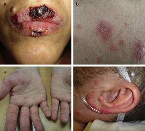 Imágenes clínicas de eritema multiforme. a) Afectación de la mucosa oral en paciente con herpes simple y eritema multiforme cutáneo-mucoso. b) Eritema multiforme atípico compuesto por pápulas eritematosas con descamación y exulceración central. c) Lesiones en diana típicas con halo edematoso y eritematoso con centro claro. d) Variante papular atípica compuesta por pápulas eritematosas edematosas de morfología oval.
