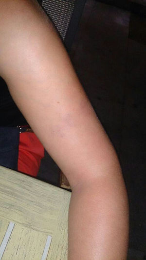 Lesión eritemato-violácea con patrón reticular localizada en cara externa de tercio medio de miembro superior izquierdo.