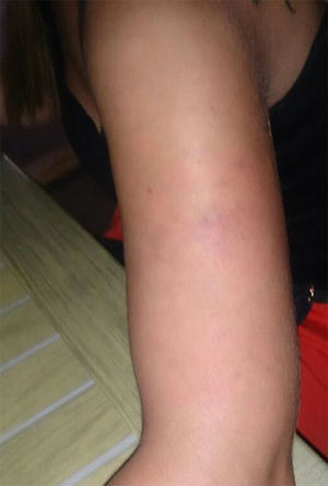 Lesión eritemato-violácea. Circulación colateral proximal.