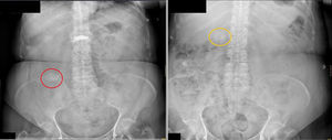 Izquierda: Radiografía de abdomen realizada en el momento de la consulta de la paciente. Se observa imagen redondeada, de gran tamaño, densidad cálcica, sobre hueso iliaco derecho (rodeada mediante círculo), asas de intestino delgado en marco gastrocólico y hemiabdomen izquierdo, presencia de gas distal. Derecha: Radiografía de abdomen realizada el año anterior, donde se observa la misma imagen, situada bajo la sombra hepática (rodeada mediante círculo).