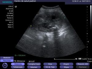 Ecografía de riñón derecho con medida longitudinal.