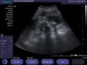 Ecografía de riñón derecho donde se aprecia un parénquima desestructurado y calcificaciones groseras con sombra acústica posterior.