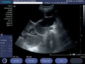 Imagen obtenida con sonda a nivel de hipogastrio: corte longitudinal que muestra masa anecoica multilobulada con tabiques finos que impide, por desplazamiento, la visualización del resto de las estructuras anatómicas abdominales a ese nivel.