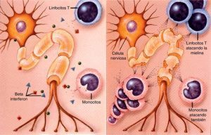 Diferencia entre axón de una neurona normal (izquierda) y el de un enfermo de E.M.