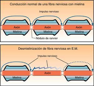 En este diagrama se aprecia la diferencia en la conducción nerviosa entre un axón mielínico (arriba) y uno con pérdida de mielina en la esclerosis múltiple (abajo).