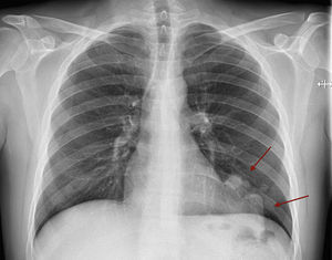 Radiografía de tórax en la que se aprecia una opacidad pulmonar en el lóbulo inferior izquierdo.