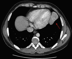 Tomografía axial computarizada de tórax que presenta una masa heterogénea en el lóbulo inferior izquierdo que recibe aporte vascular arterial desde el tronco celíaco y drenaje venoso sistémico a la vena cava inferior.