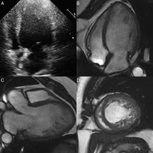 A. Ecocardiograma transtorácico. Plano apical de 4 cámaras donde se intuye una hipertrabeculación apical. B-D. Resonancia magnética cardiaca, 4 cámaras, 3 cámaras y eje corto. Se observa la relación miocardio no compactado/compactado.
