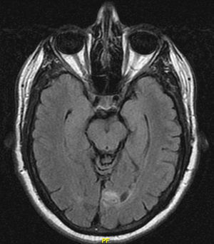 Resonancia magnética cerebral. Infarto subagudo-crónico en el lóbulo occipital izquierdo.