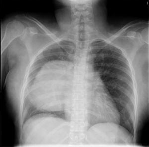 Radiografía de tórax posteroanterior. Gran masa mediastínica de bordes nítidos que se extiende hacia el pulmón derecho.