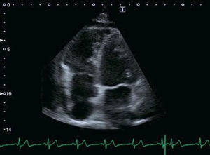 Ecocardiograma transtorácico en un plano apical cuatro cámaras donde se objetiva la implantación baja de la válvula tricúspide sugestiva de anomalía de Ebstein.