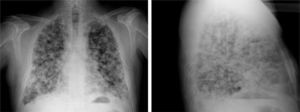 Radiografía simple de tórax PA y L en la que se aprecia un infiltrado macronodular bilateral formando una imagen en «suelta de globos».