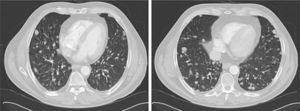 Cortes axiales de TC mostrando imágenes macronodulares bilaterales compatibles con metástasis pulmonares.