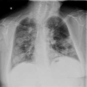 Radiografía PA de tórax: infiltrados bilaterales.