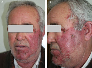 Se aprecian las lesiones en forma de placas eritematoedematosas afectando el labio inferior, el mentón y la mejilla. A) Pabellón auricular y zona temporal izquierda. B) Sin sobrepasar la línea media, localización que corresponde al dermatoma V1 y parcialmente V2 del nervio trigémino y área sensitiva del nervio facial. En algunas zonas se aprecian las pequeñas vesículas en fase costrosa.
