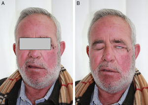 Dos días más tarde el paciente presentó mejoría de sus lesiones cutáneas, pero acudió con síntomas de parálisis facial periférica. A) El paciente presentaba desviación de la comisura bucal hacia la derecha, con desaparición de las arrugas del lado izquierdo y aplanamiento del surco nasogeniano en dicho lado. B) «Fenómeno de Bell»: el paciente es incapaz de cerrar completamente el ojo izquierdo, y además, el globo ocular se desvía hacia arriba y hacia fuera cuando el enfermo intenta cerrar el párpado.