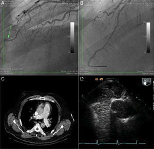 A. Coronariografía con la imagen del trombo (flecha). B. Coronariografía sin trombo, en la que se observa la anatomía arterial sin irregularidades tras la aspiración del trombo. C. Imagen de la angio-TAC torácica, en la que se observa un defecto de repleción en ambas venas pulmonares. D. En el ecocardiograma se observa el foramen oval permeable.