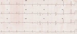 Electrocardiograma al ingreso con patrón Wellens tipo 1.