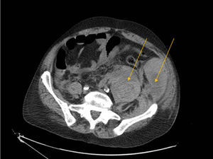 Imagen de TC abdominal en corte transversal que evidencia hematoma en músculo ilíaco y psoas izquierdos (flecha).
