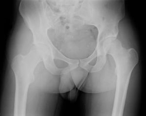 Imagen correspondiente a la radiografía simple de pelvis que muestra un aumento de partes blandas en torno a la articulación coxofemoral derecha.
