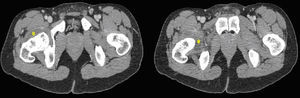 Imágenes correspondientes a la TAC realizada a nuestro paciente: ambos cortes muestran la colección líquida y el realce capsular en la articulación coxofemoral derecha (*).