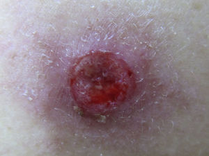 Lesión en la espalda de bordes eritematosos y sobreelevados con fondo blanquecino y supurativa.